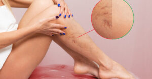 żylaki - jak sobie z nimi poradzić