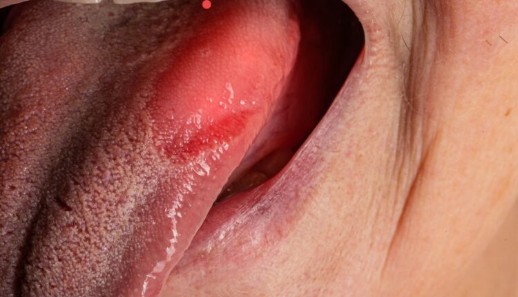 Stan zapalny języka