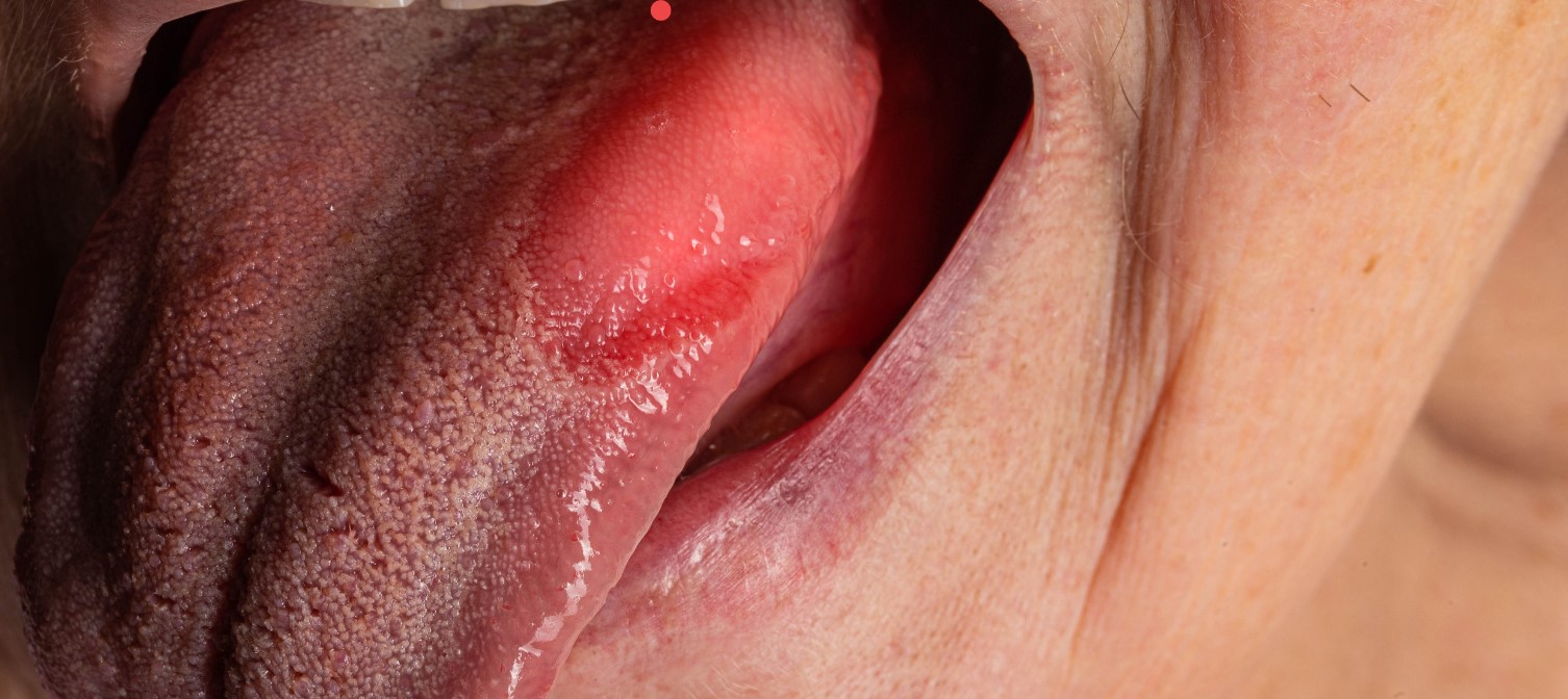 Stan zapalny języka