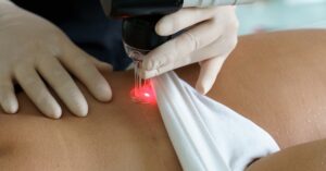 Leczenie blizn - jak zrobić to, by nie został ślad?