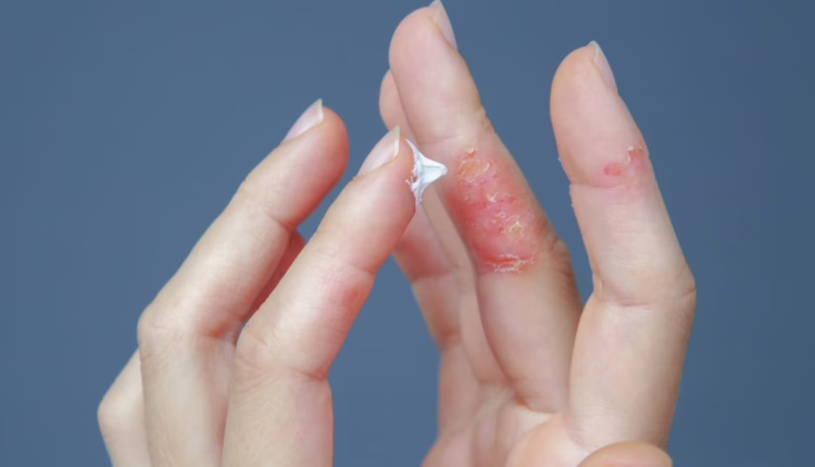 Naturalne leczenie egzemy