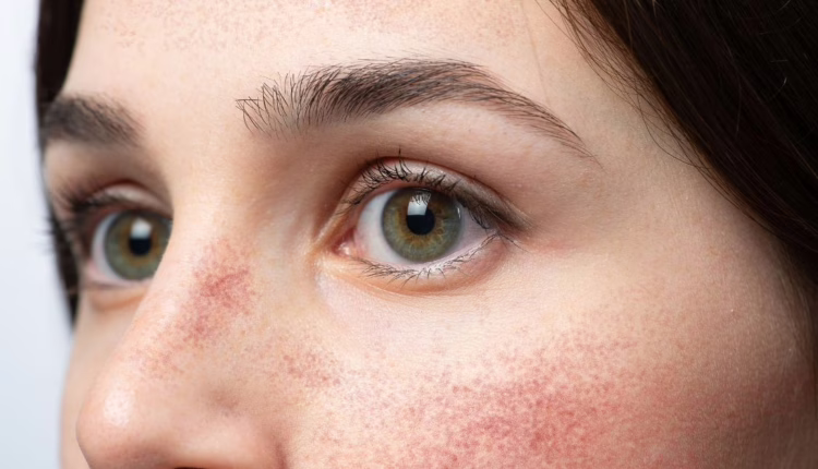 Jakie są objawy i jak poradzić sobie z rumieniem zakaźnym?