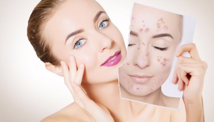 jak usunąć przebarwienia na twarzy