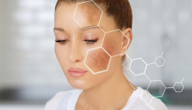 Jak skutecznie niwelować przebarwienia