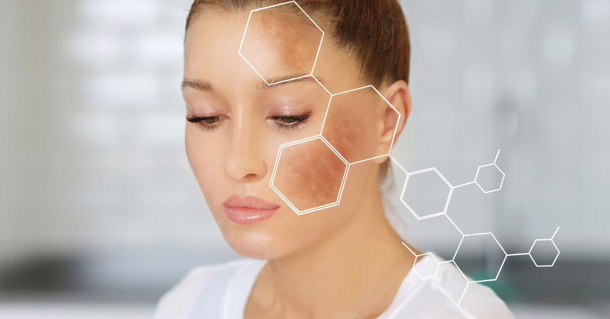 Jak skutecznie niwelować przebarwienia