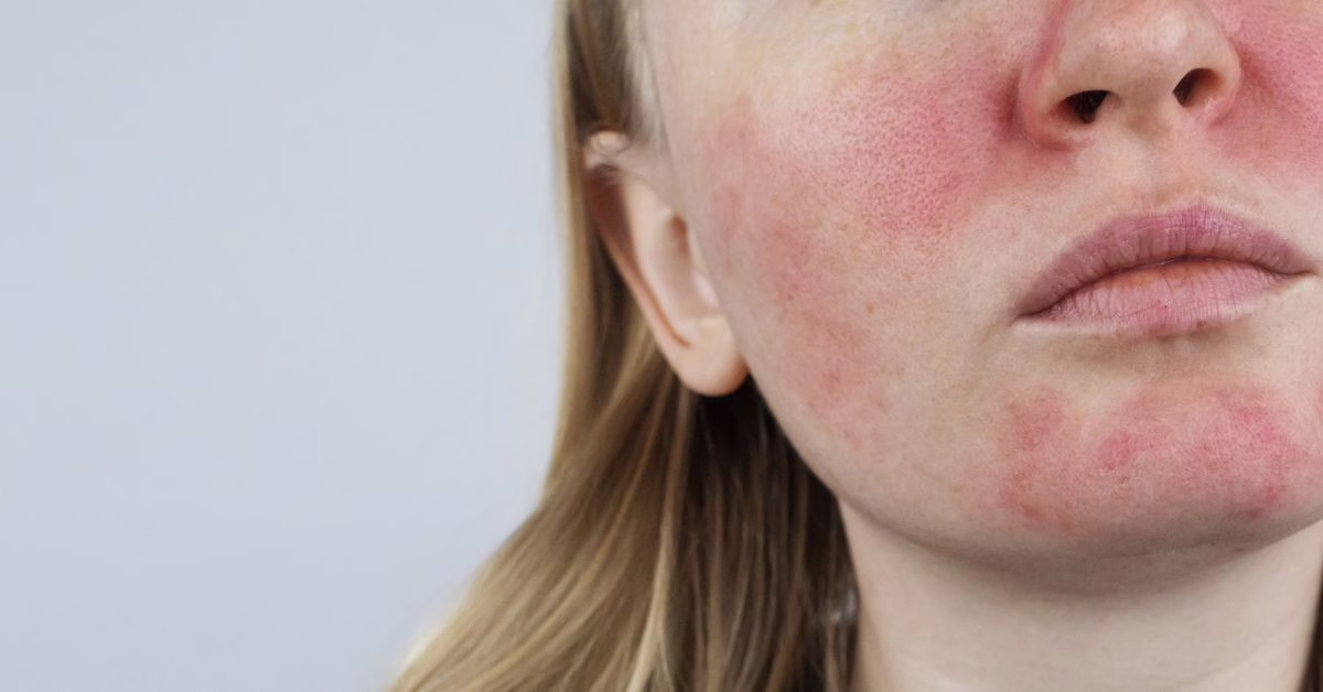 jak wyleczyć trądzik różowaty