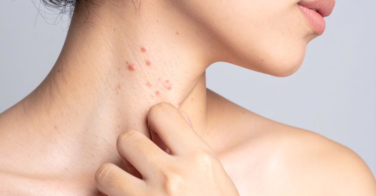 naturalne sposoby na półpasiec